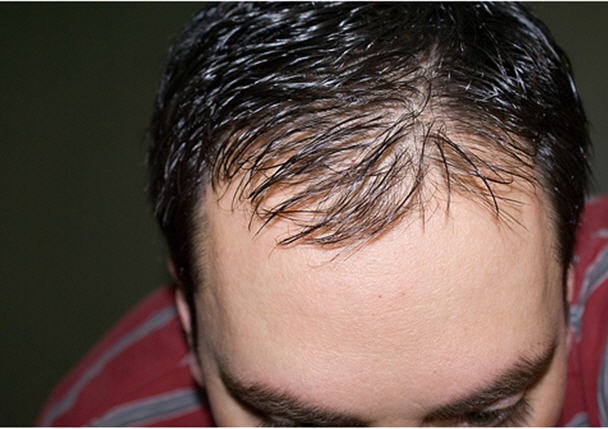 5 Ways to Fight Premature Balding (Things To Do) | Male Standard